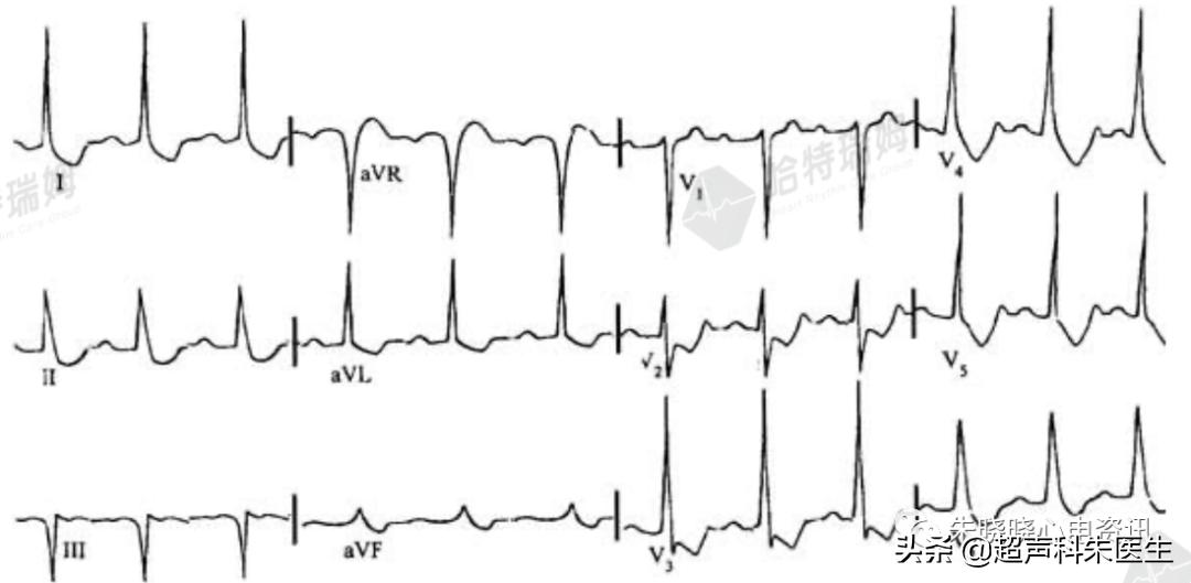 t波倒置诊断,t波倒置如何区分严重程度
