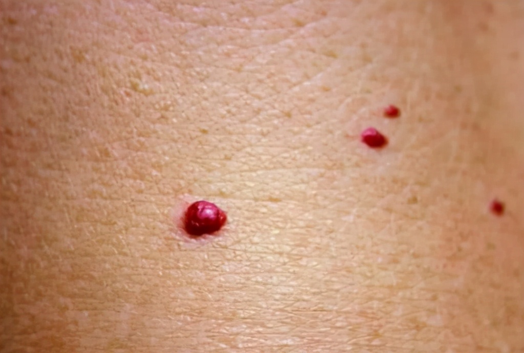 肝癌早期皮肤会出现红点吗,肝癌患者出现皮肤红色斑点