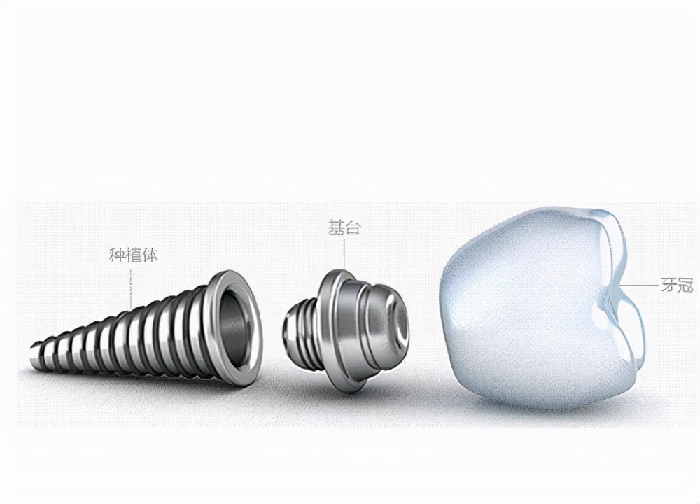 种植牙种植体最好的是哪几种,种植牙最好的种植体是什么