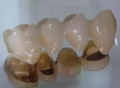 如何挑选烤瓷牙材料,怎样选择适合你的烤瓷牙