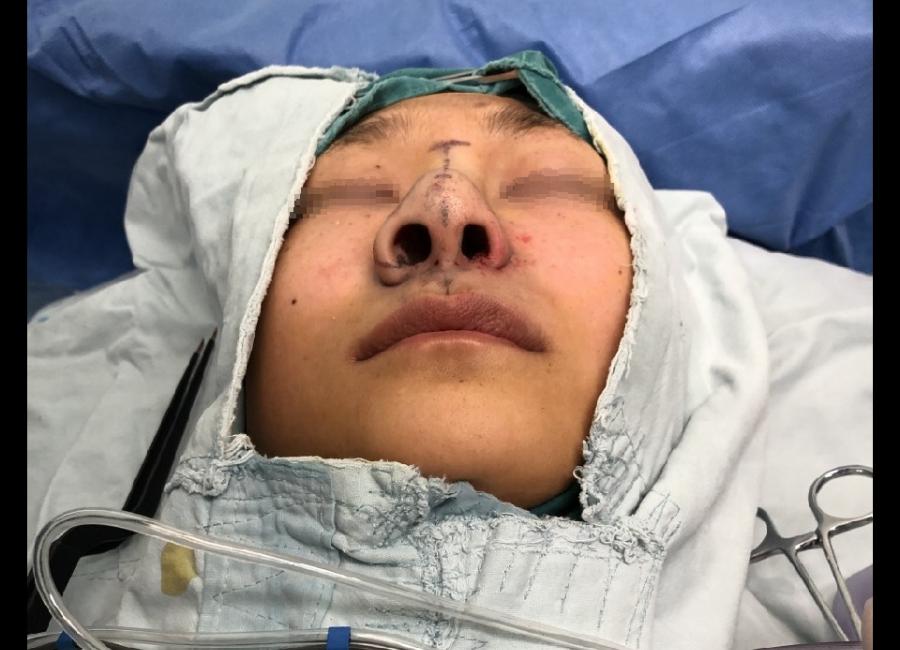 鼻头缩小鼻翼缩小前后对比图,鼻头缩小跟缩小鼻翼有区别吗