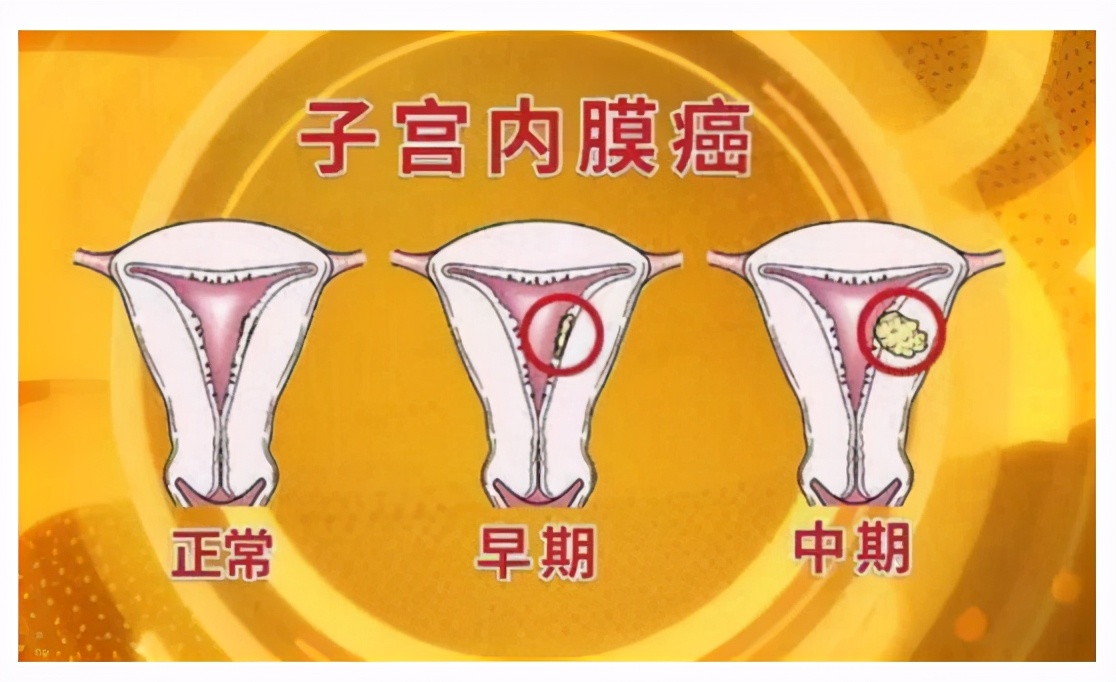 了解子宫疾病，看这一篇就够了
