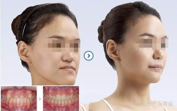 12岁孩子发育期需要注意哪些问题,12岁孩子高度近视矫正要多少钱