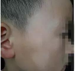 孩子脸花一块白一块怎么回事,小孩脸上花一块怎么回事
