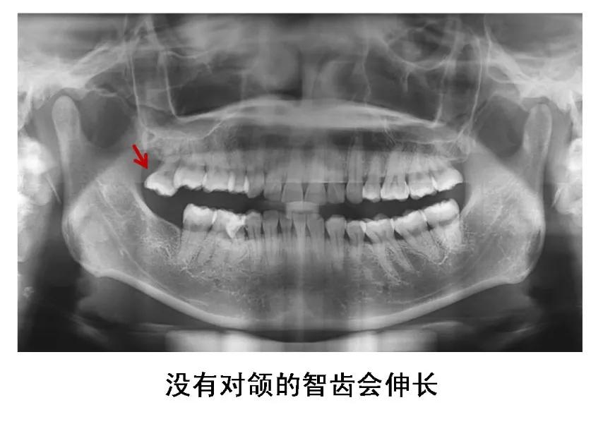 Helen齿科中心——智齿是不是非拔不可？