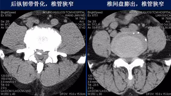 腰椎管狭窄的磁共振诊断标准,腰椎轻度退行性变化椎间盘膨出