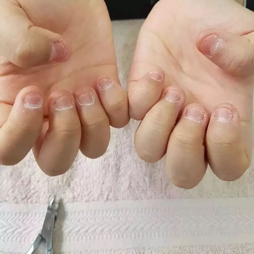 小孩指甲短秃是怎么回事,孩子指甲很秃不长怎么办