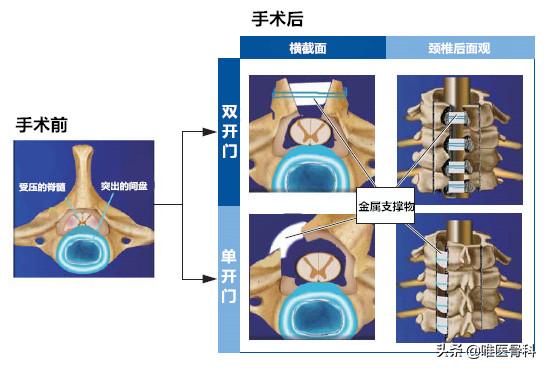 颈椎病做手术哪种方式最好,开放手术和微创手术的区别