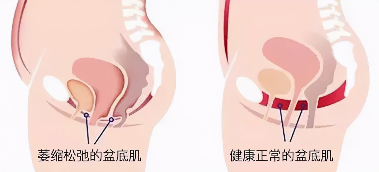 产后4年漏尿修复盆底肌简单动作,产后漏尿修复盆底肌手法简单动作