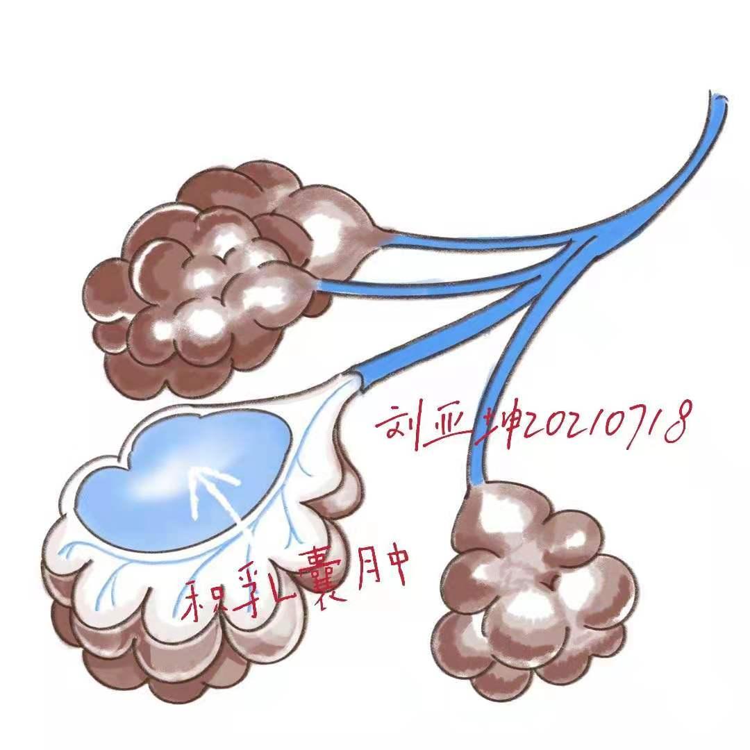 哺乳期乳房疙疙瘩瘩的,哺乳期乳房有疙瘩影响乳汁吗
