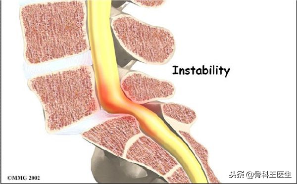 腰椎滑脱可以复位吗,第四腰椎向前滑脱1度可以复位吗