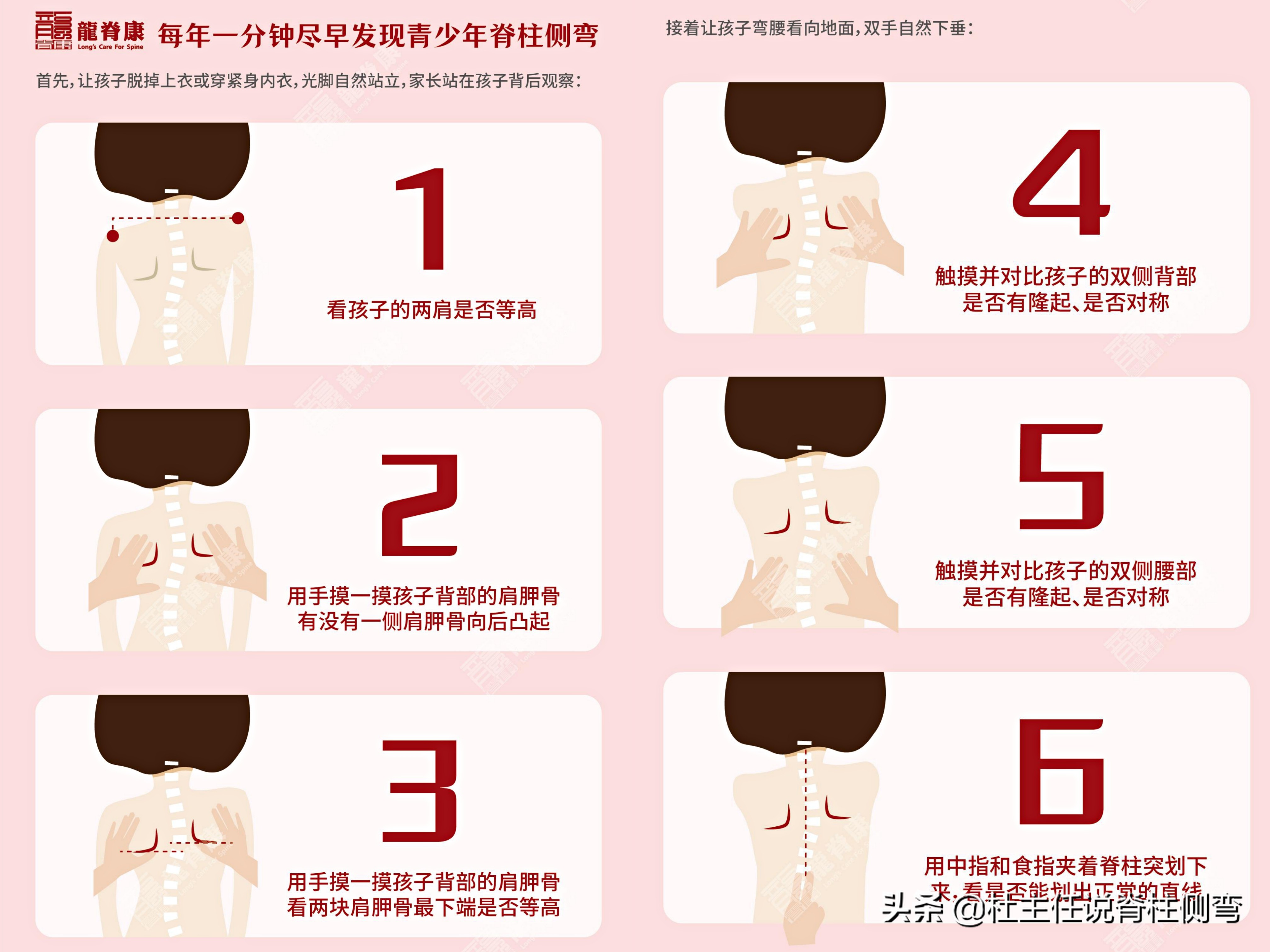 14岁女孩侧弯治疗一年后,12岁女孩脊柱s型侧弯17度怎么治