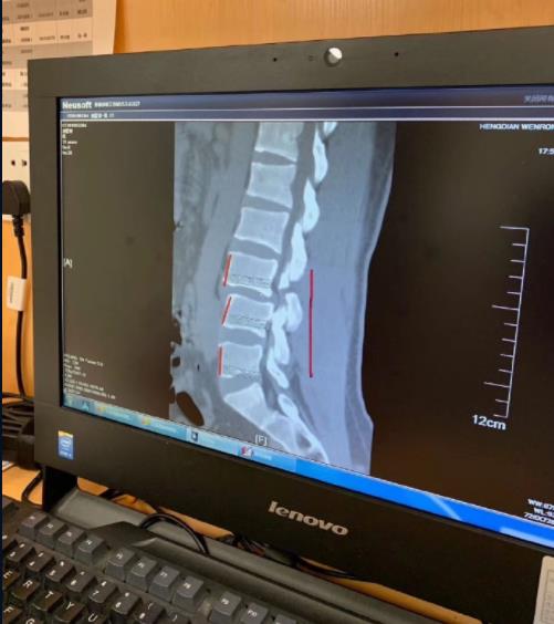 武僧一龙腰部受伤视频,武僧一龙复出