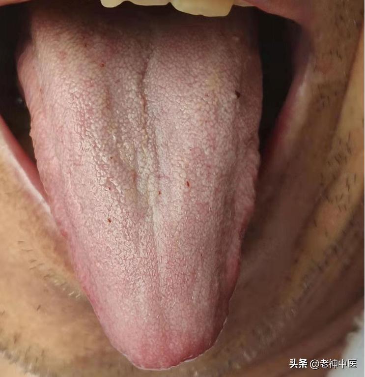 治疗幽门杆菌胃炎的药物有哪些,胃炎幽门螺杆菌感染怎么治疗