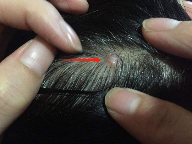 头皮上总长痘痘,头皮上长痘痘抠破了怎么办