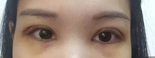 请别再怀疑潘贰做双眼皮手术切肌肉了，希望这是我最后一次澄清