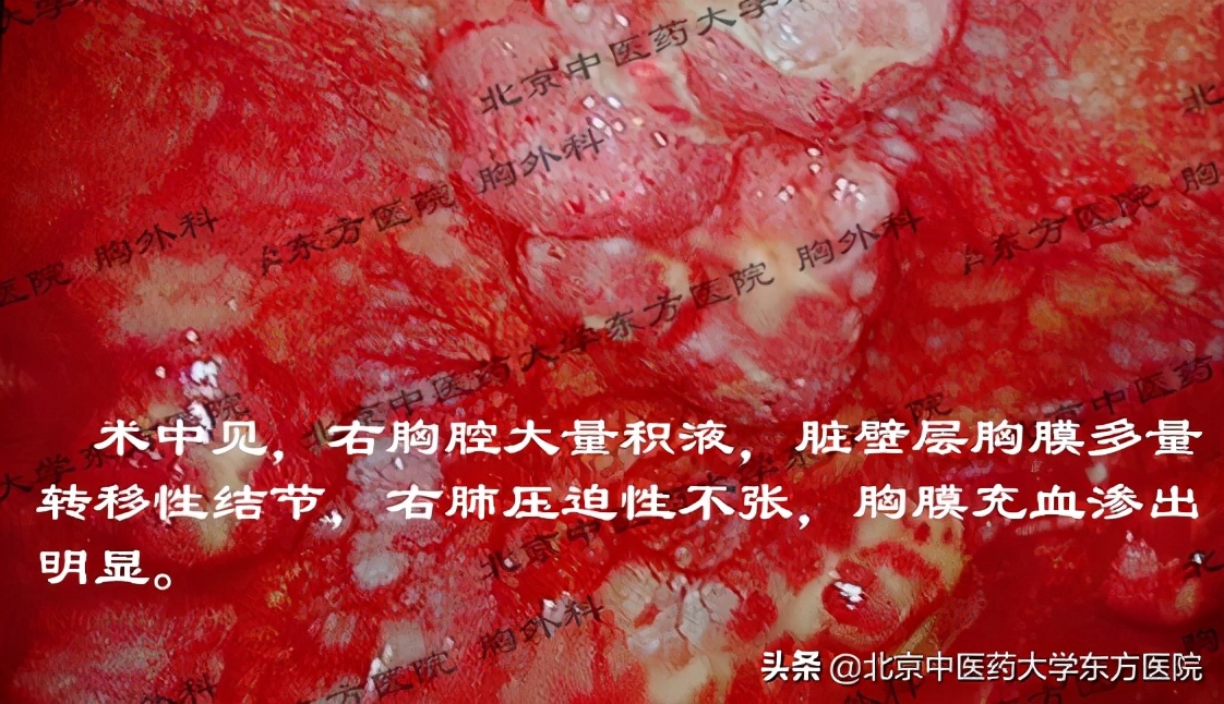 北京治疗胸腔积液哪个医院权威,中医治疗心脏胸腔积液