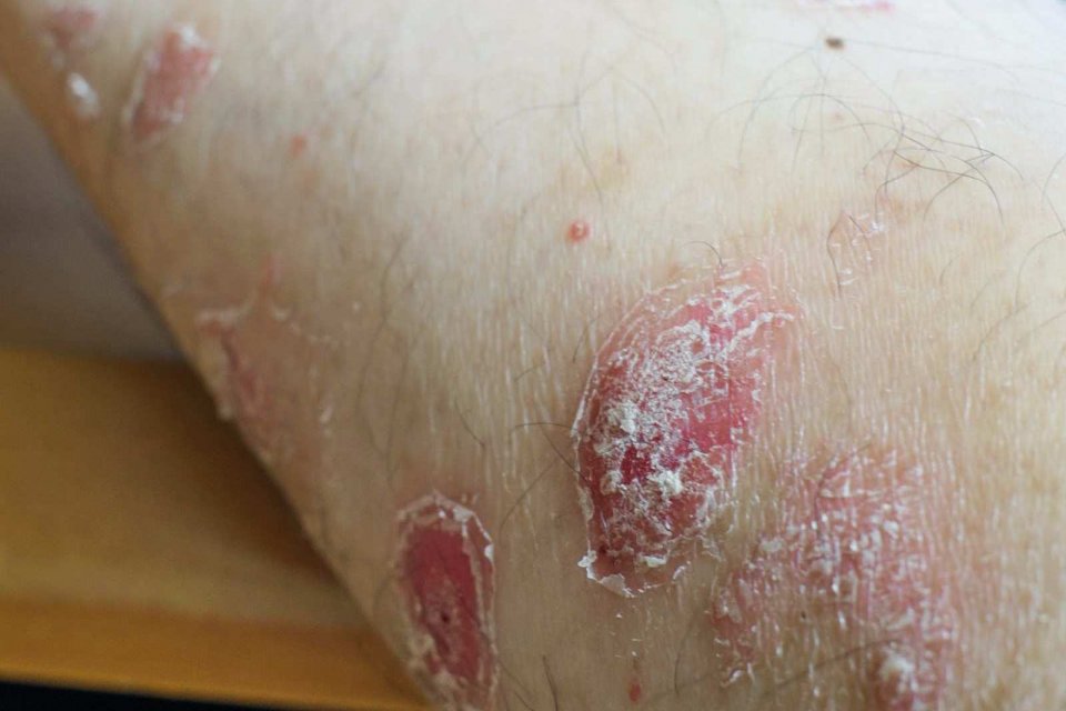 银屑病的早期先兆,银屑病的早期10个征兆