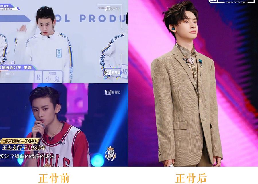 正骨是不是可以增高,明星正骨有哪些好处