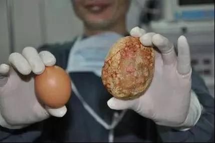 男子尿不出尿,男子突然尿无力