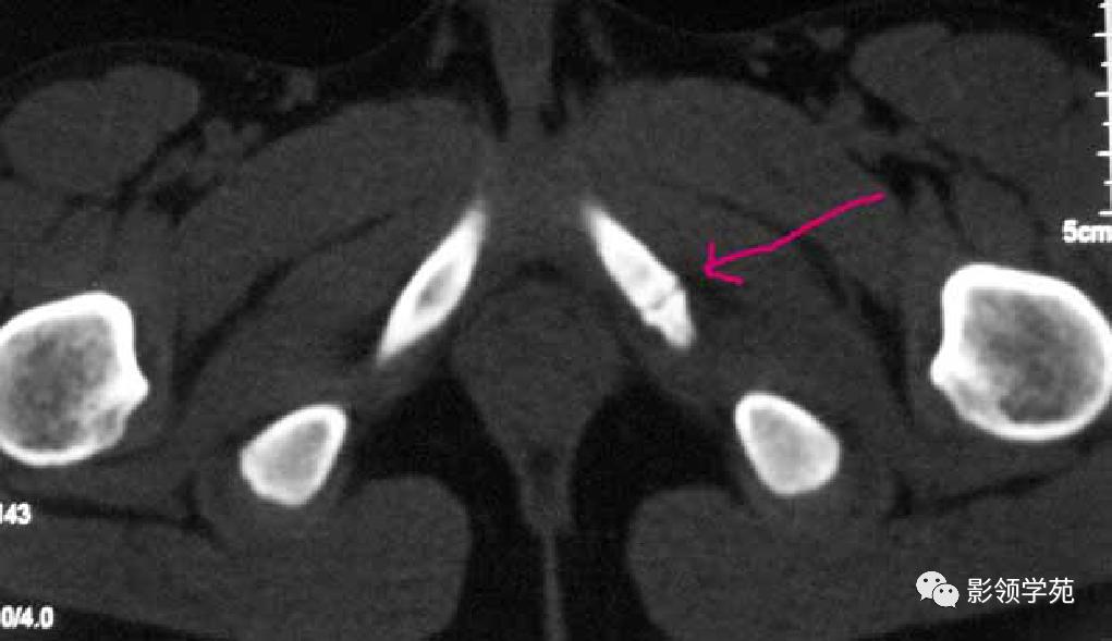 桡骨远端骨折引起尺骨变异,撕脱骨折一个月无明显骨痂形成