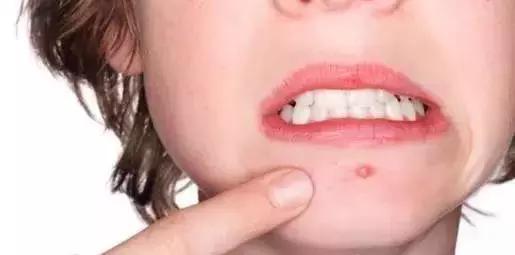 粉刺是什么应该怎么治,粉刺怎么样才算好了