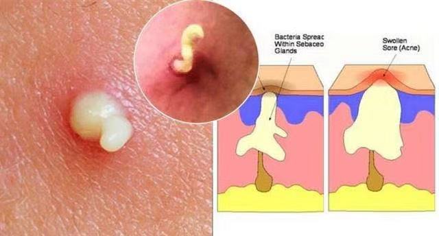 痘痘把白色的挤出来是不是好得快,皮肤上有痘痘挤出来白色米粒