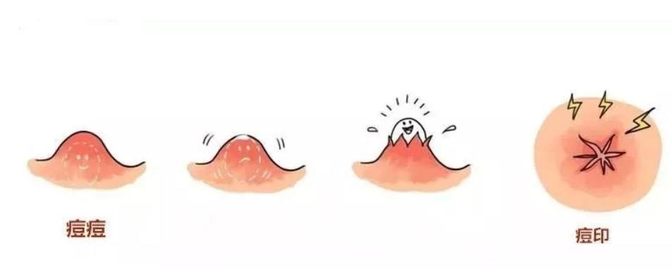 脸上有痘印该用去痘印精华吗,反复起痘有痘印应该用什么精华