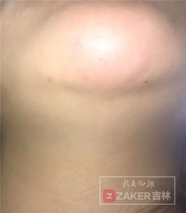 为变美做整容手术,女孩为变美注射玻尿酸