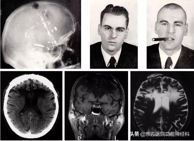 精神病人的前世,精神科药物的前世今生