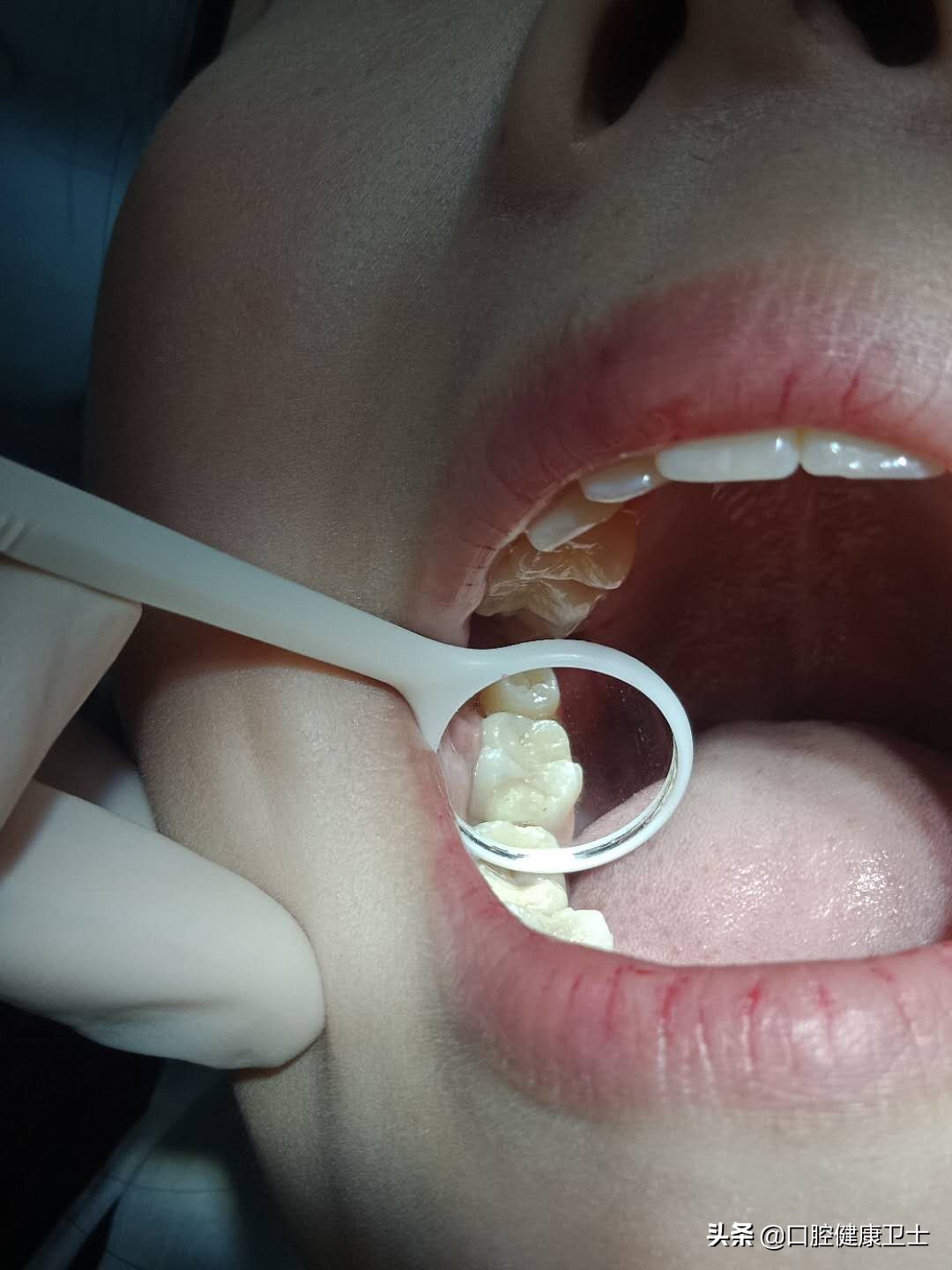 补牙后的牙缝越来越大怎么办,补牙之后牙缝塞东西导致牙龈痛