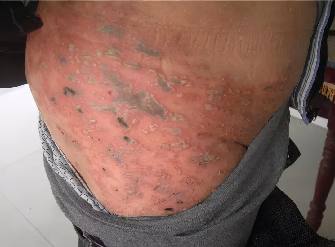 马齿苋治疗疱疹后遗神经痛吗,长了疱疹后遗神经痛多久复发