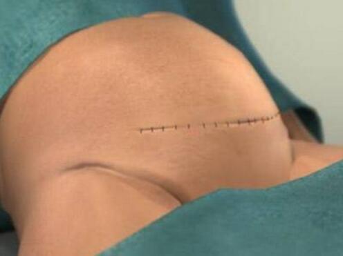 剖腹产用美容线好还是拆线比较好,剖腹产美容线和拆线的区别