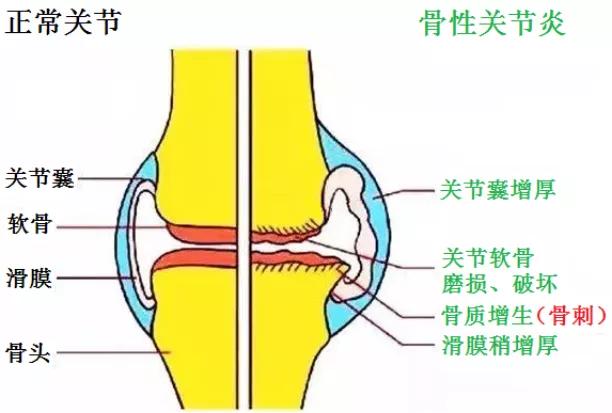 半月板损伤骨刺积液膝关节疼痛,骨刺引起的膝关节疼痛怎样治疗