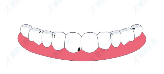 蛀牙牙龈出血怎么办,牙齿出血是不是蛀牙了怎么才能好
