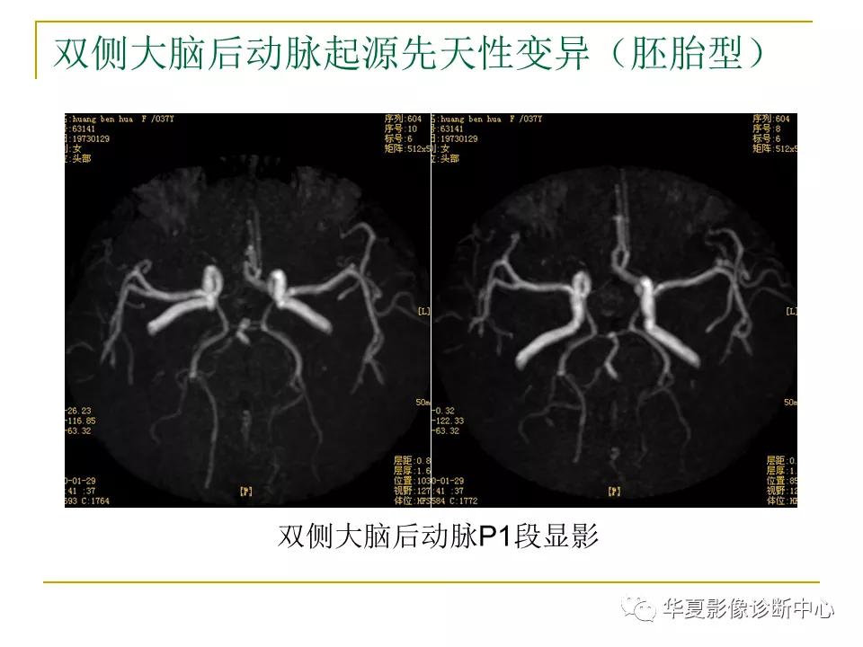 中国人脑立体定向mri应用解剖图谱,脑mri示意图