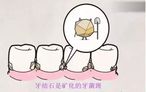 牙科不告诉你去牙结石的秘密,牙结石科普