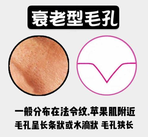 夏季毛孔堵塞怎么办,夏季皮肤毛孔粗大油腻怎么办