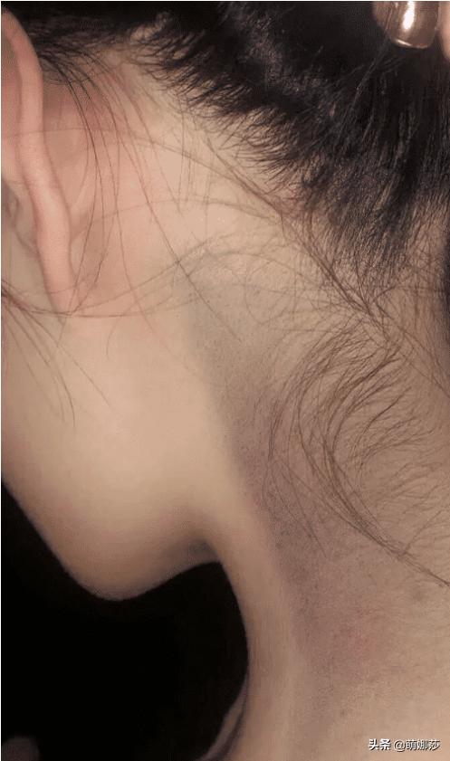 睡觉无缘无故脖子青了一小块,睡醒发现脖子有一圈青了
