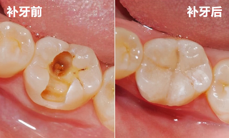 补牙里面灌的水,补牙水很深