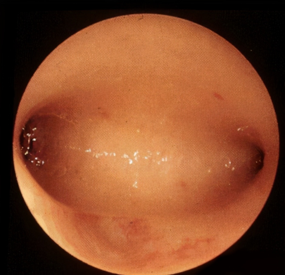 宫腔粘连手术过后第二次月经变少,月经量少和流产刮宫有关系吗