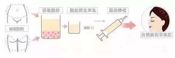 法令纹苹果肌下垂有什么办法改善,如何改善法令纹和苹果肌下垂