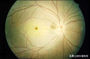 老人单侧眼睛突然视力下降,老人单眼视力下降眼底病变