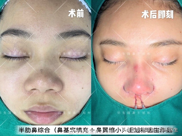 大鼻头缩小的改善原理,鼻头毛孔粗大如何改善缩小毛孔