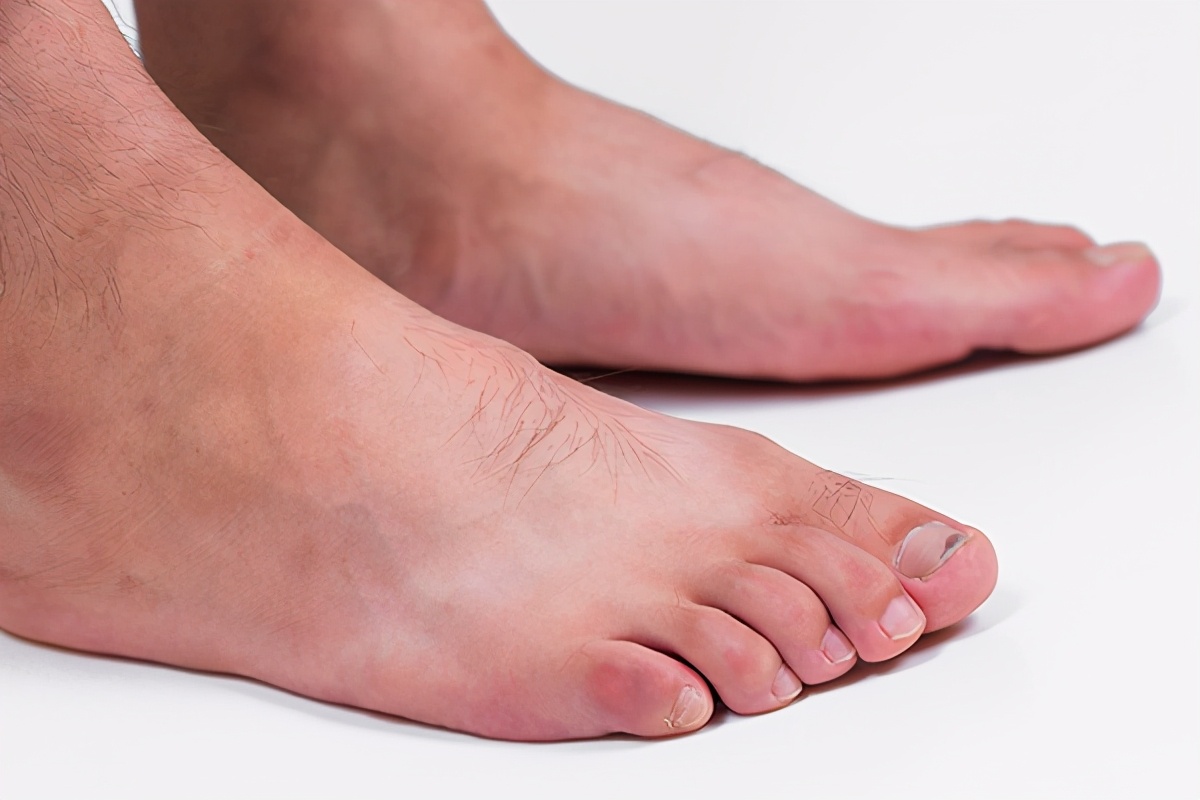 脚趾甲总往肉里长，怎么办？如何缓解甲沟炎？