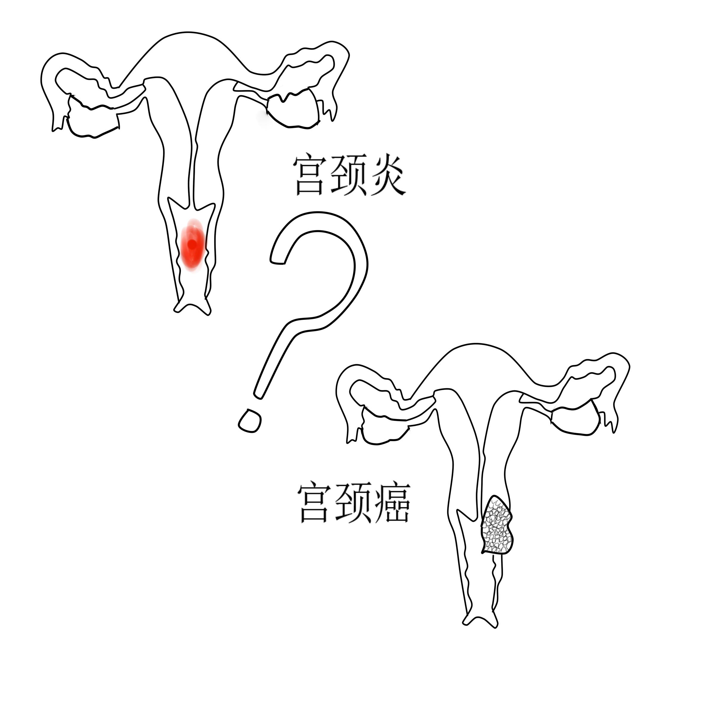 谈谈宫颈癌的症状,谈谈宫颈环扎术护理