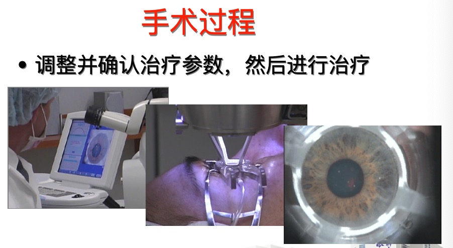 做过lasik手术后还可以做飞秒吗,lasik激光近视眼手术有什么优势