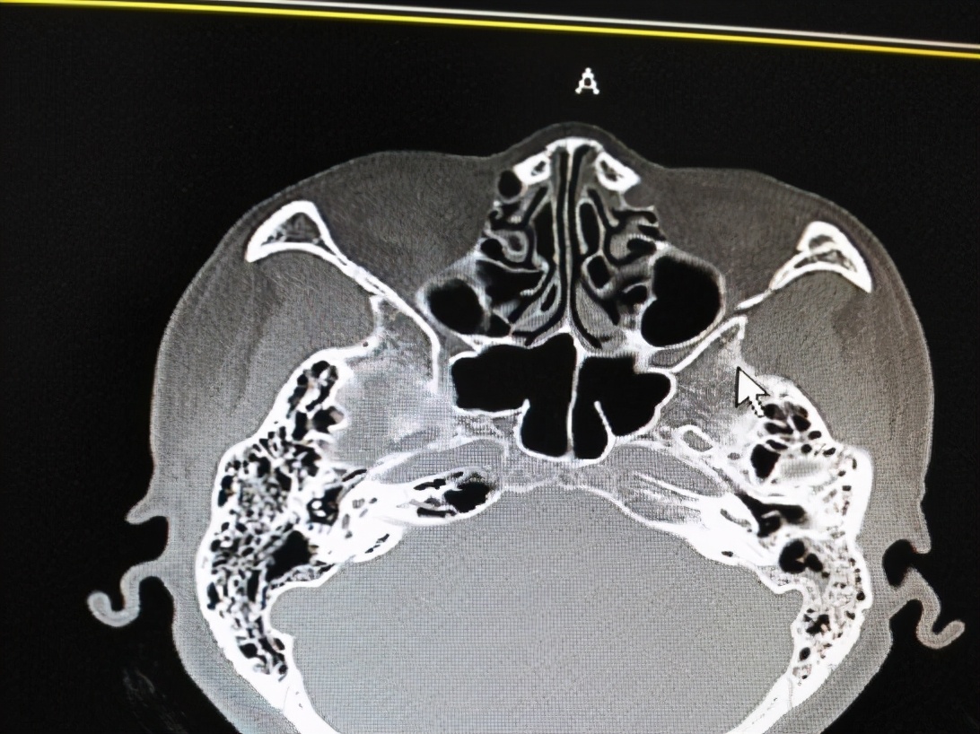 耳屎结成硬块一掏就出血,耳朵里耳屎粘在耳壁上像个瘤