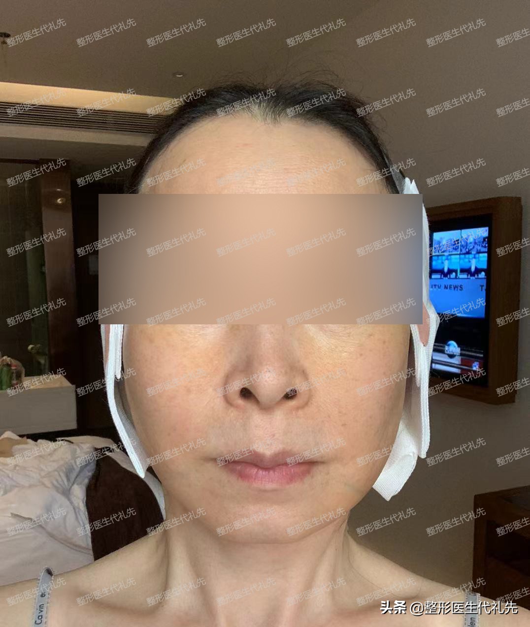 拉皮手术能彻底去除法令纹吗,拉皮术后法令纹木偶纹还在怎么办