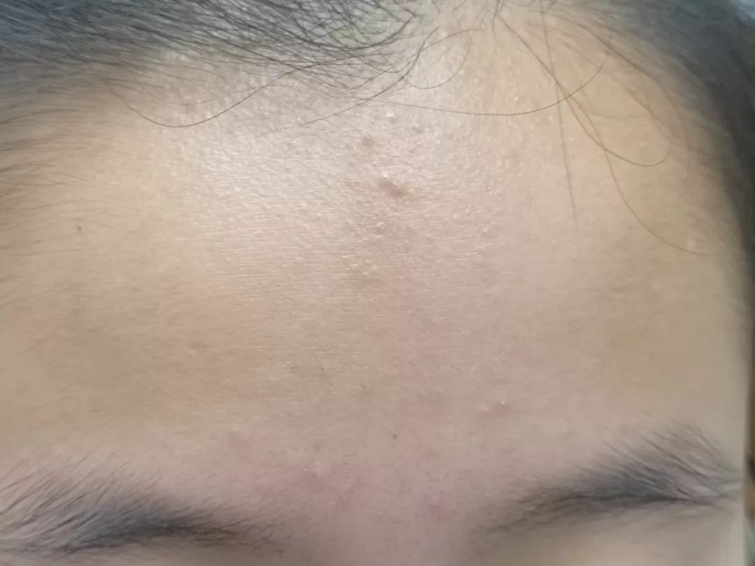 皮肤科医生最喜欢的痘痘